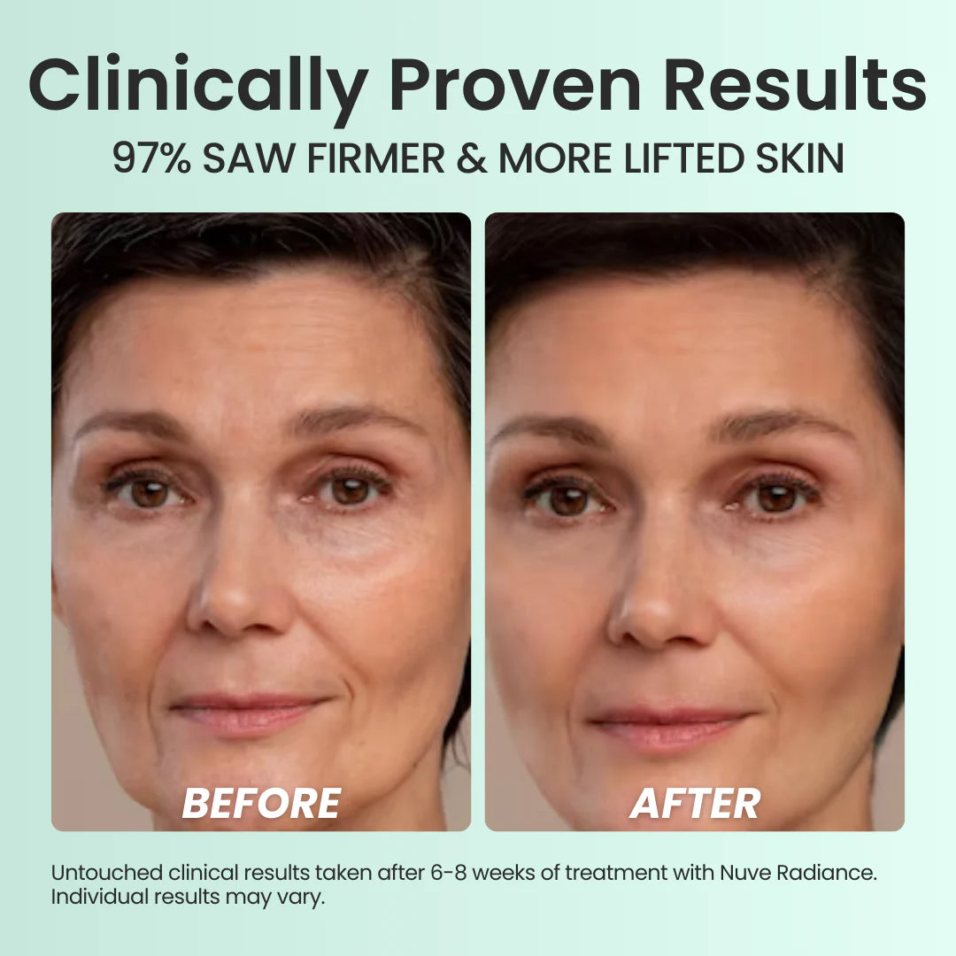 Nuve Radiance – At-Home RF Lifting & Firming