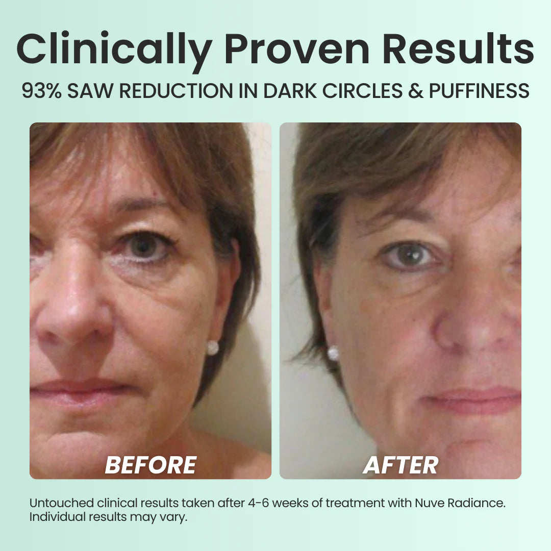 Nuve Radiance – At-Home RF Lifting & Firming