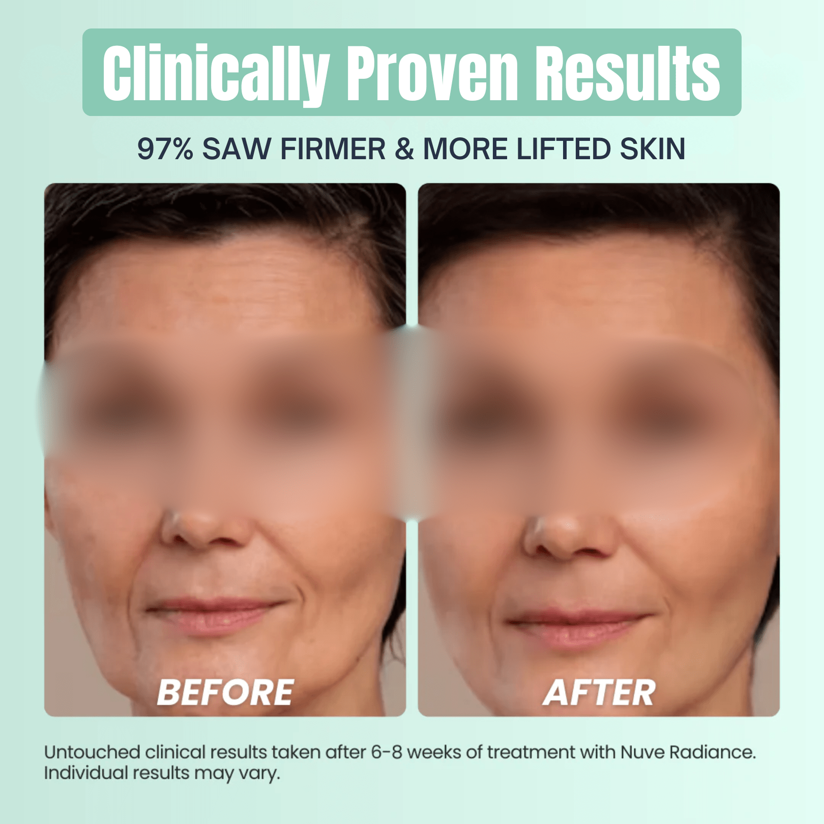 Nuve Radiance – At-Home RF Lifting & Firming