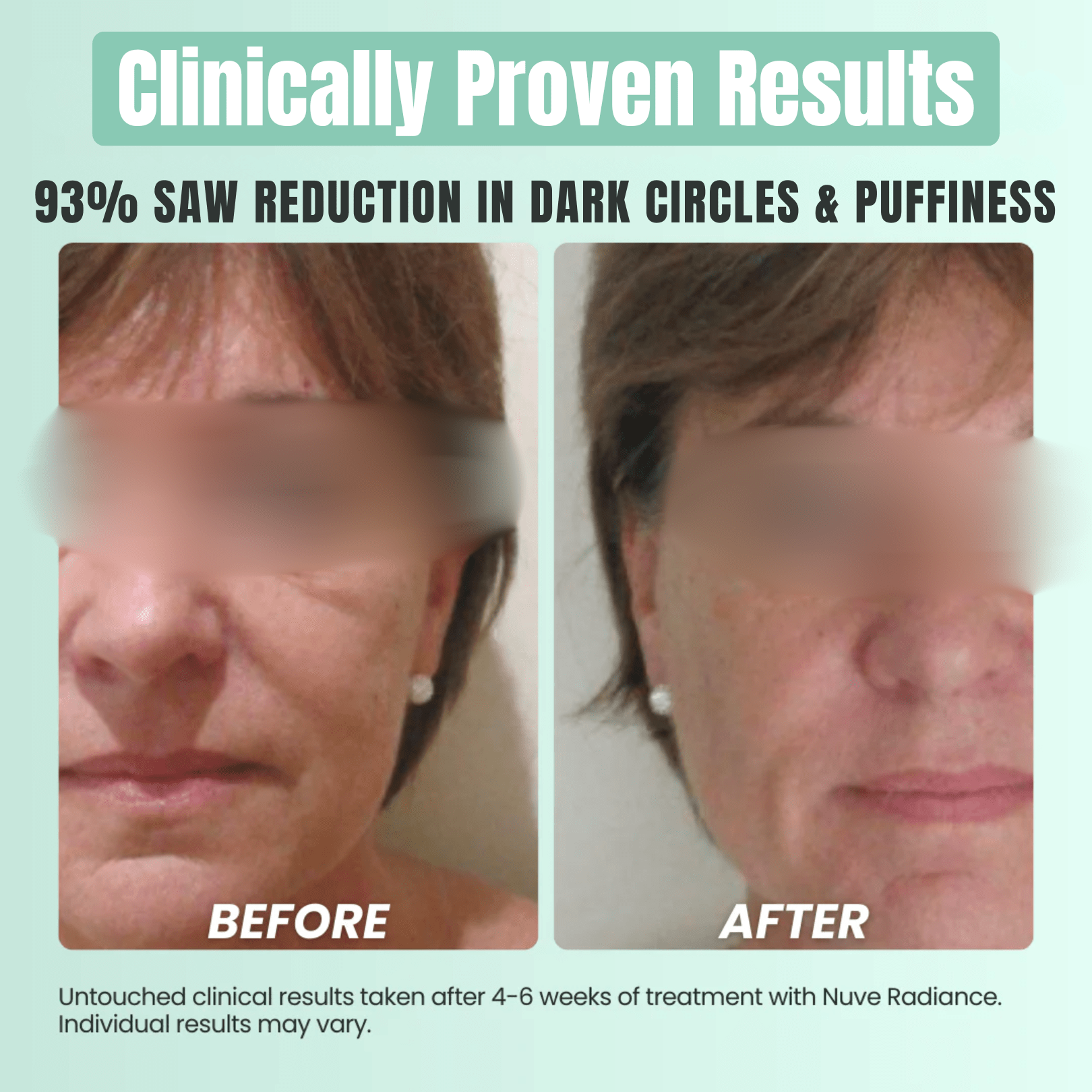 Nuve Radiance – At-Home RF Lifting & Firming
